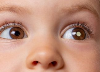 Especialistas explicam o retinoblastoma, câncer que acomete os olhos de crianças