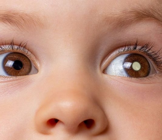 Especialistas explicam o retinoblastoma, câncer que acomete os olhos de crianças