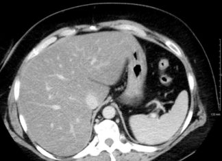 Gordura no fígado: o que é, causas e sintomas