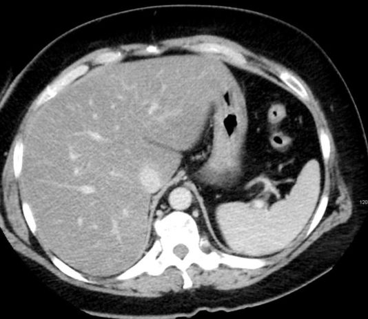 Gordura no fígado: o que é, causas e sintomas