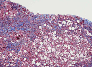 Estudo encontra relação entre hepatite aguda em crianças e covid