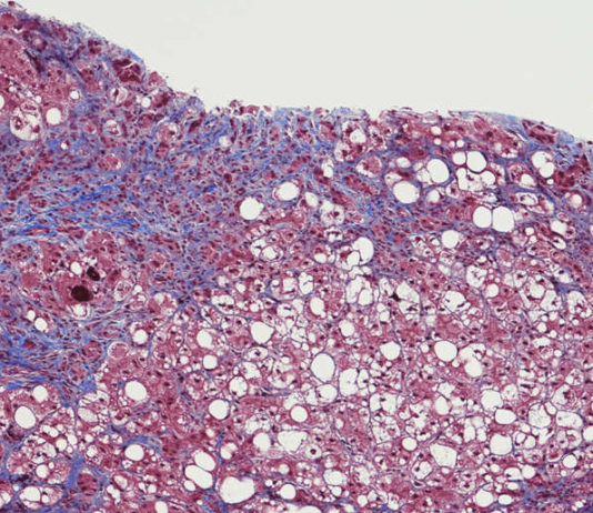 Estudo encontra relação entre hepatite aguda em crianças e covid