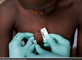 Brasileiro é primeiro infectado por varíola dos macacos na Alemanha