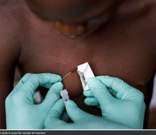 Brasileiro é primeiro infectado por varíola dos macacos na Alemanha