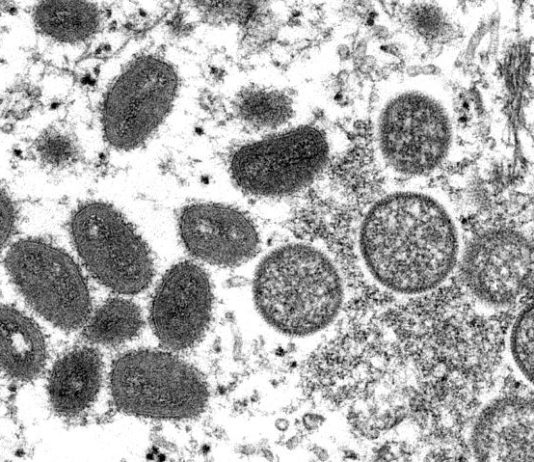 Brasil tem mais de 200 casos confirmados de varíola dos macacos