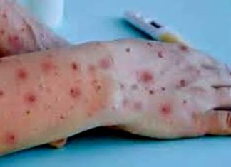 Confirmado primeiro caso de varíola dos macacos em Balneário Camboriú