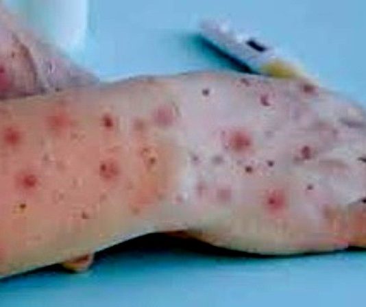 Confirmado primeiro caso de varíola dos macacos em Balneário Camboriú