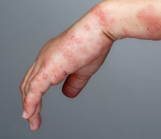 Casos de esporotricose em humanos e gatos aumentam em Itajaí