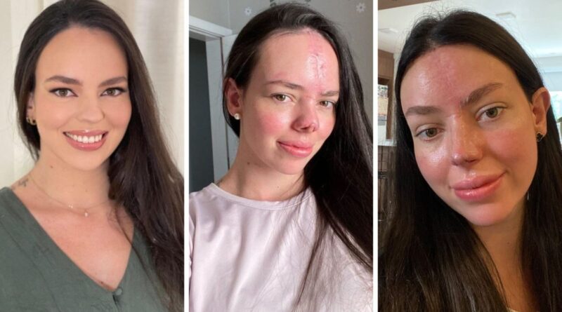 ‘Voltei a me reconhecer’: doula mostra resultado de reconstrução facial sete meses após acidente grave em SC